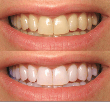 Leamingtonroad  Teeth Whitening Image