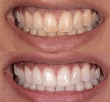 Leamingtonroad  Teeth Whitening Image
